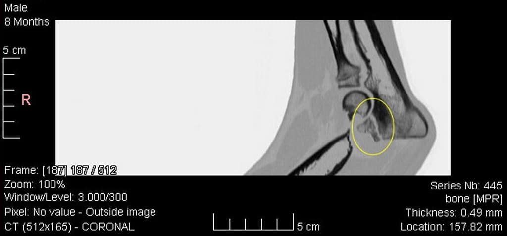 Elleboogdysplasie, ED